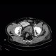 Lung metastases, cavitated metastases, bladder carcinoma: CT - Computed tomography